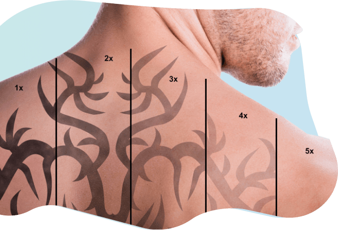 Man Tattoo Laser Removal, HD Png Download - Transparent PNG Free Download | PNGio