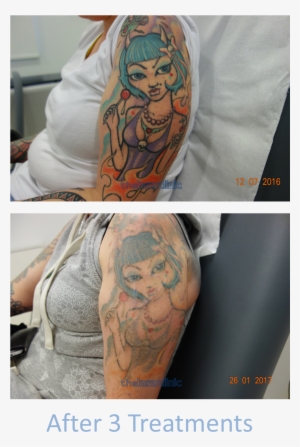 Fading This Brightly Coloured Tattoo Required Only - Tattoo Laser Colour Sleeve Transparent PNG - 1012x1488 - Free Download on - Tattoo Transparent PNG Free Download